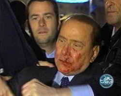 Травмы Берлускони оказались серьезнее, чем думали врачи 