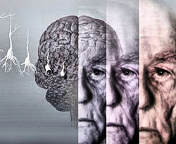 Сонливость и взгляд в одну точку могут оказаться признаком болезни Альцгеймера 
