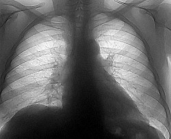 Бесплатная флюорография победит туберкулез 