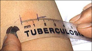Ученые создали супербыстый тест на туберкулез 
