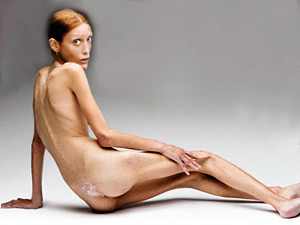Умерла модель Изабель Каро, боровшаяся с анорексией