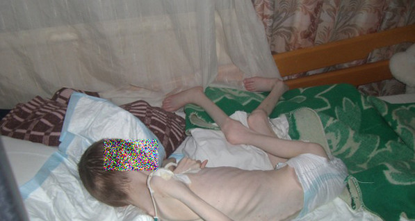Дети из российского интерната выглядят как узники концлагерей