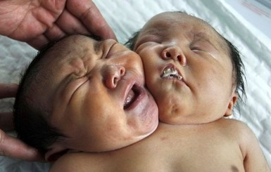 В Китае родилась двухголовая девочка