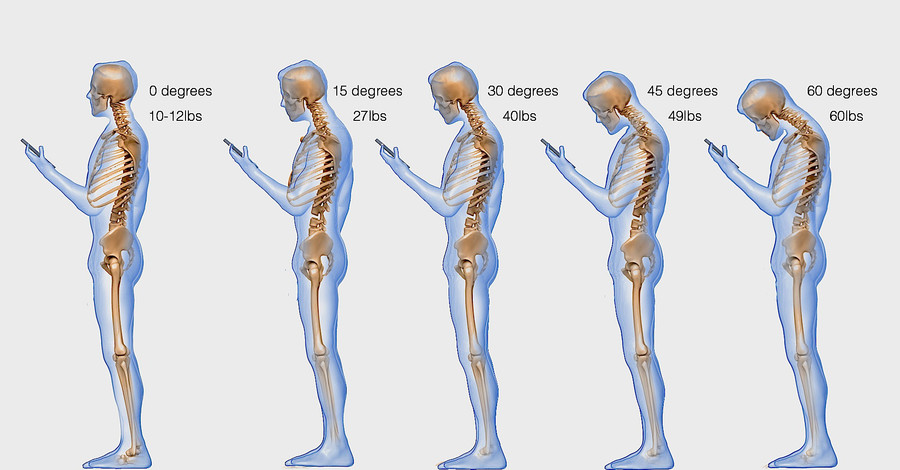 Доктора бьют тревогу: смартфоны приводят к заболеваниям позвоночника