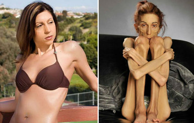Умирающая от анорексии актриса похудела до 18 килограммов и просит помощи