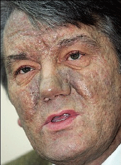 Ющенко признался, что после отравления перенес 24 операции 