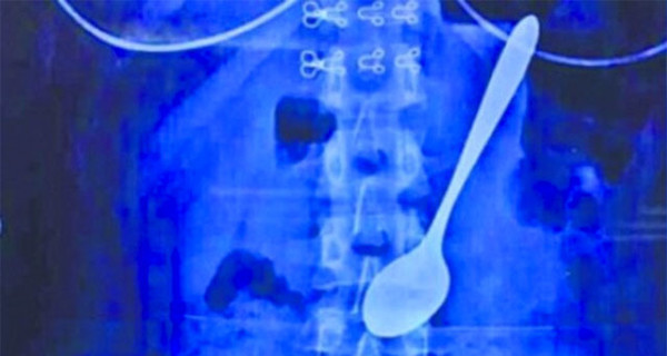 Китайские хирурги обнаружили в желудке девушки металлическую ложку