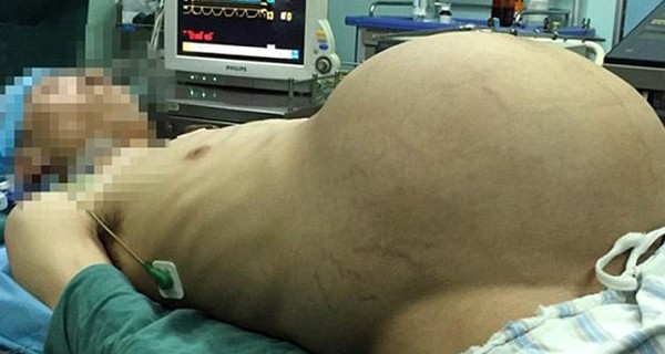 У китайца вырезали 15-килограммовую опухоль из живота