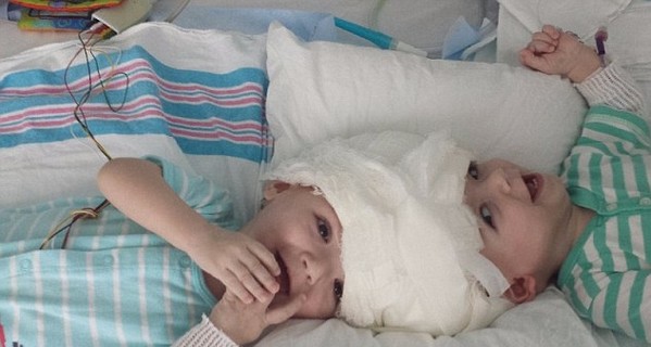 В США 20 часов шла операция по разделению сиамских близнецов, а ее стоимость покрыла страховка