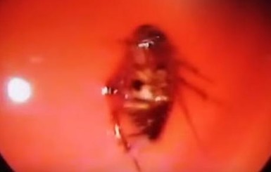 Опубликовано видео извлечения живого таракана из головы пациентки 