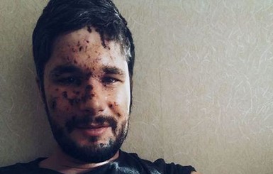 Британский фотожурналист рассказал подробности ранения в Авдеевке