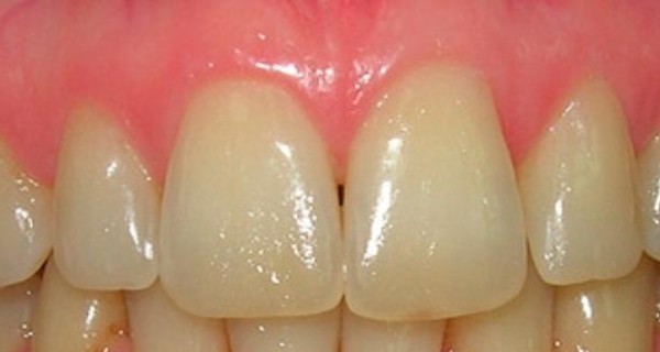 Ученые: желтые зубы – признак здоровья