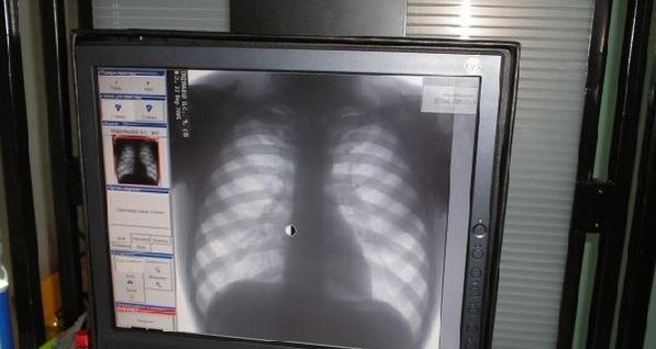 В Минздраве рассказали, как будут диагностировать туберкулез