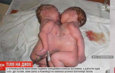 Сиамских близнецов из Черновцов переведут из роддома в областную детскую больницу