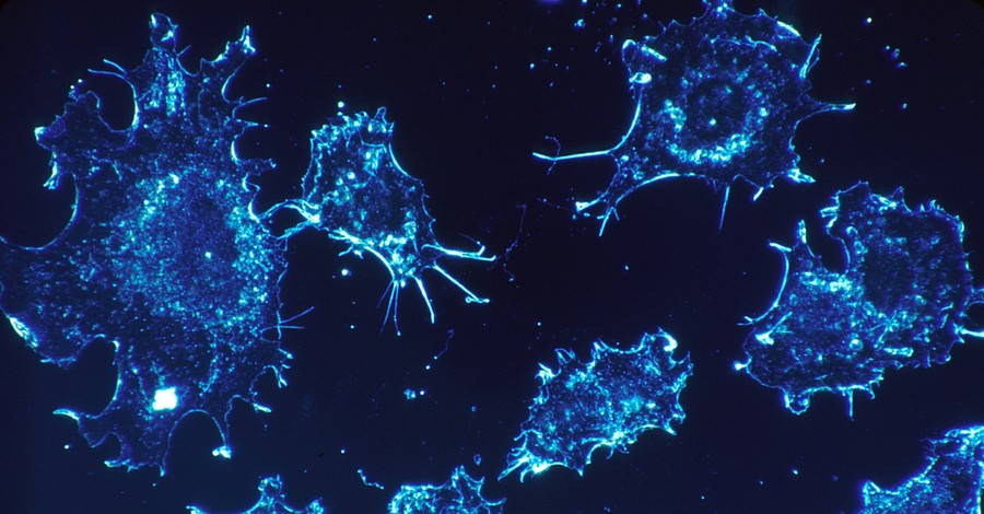 Американские учёные: Ультразвук способен обезвреживать раковые клетки, не влияя на здоровые