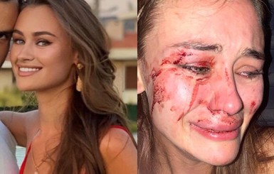 Украина обратилась к властям Турции из-за избиения модели Дарьи Кирилюк на пляже