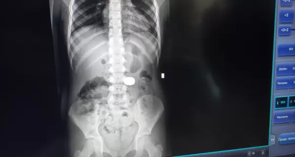 У Львові лікарі дістали зі шлунка 7-річної дитини два магніти