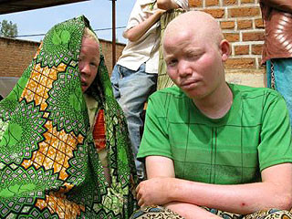 Африканцы истребляют своих альбиносов 