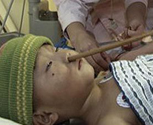 Хирурги извлекли из мозга годовалого мальчика палочку для еды 