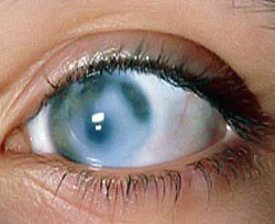 Из-за глаукомы 25 тысяч украинцев ежегодно рискуют ослепнуть 