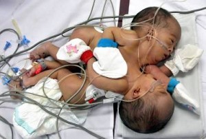 В Панаме родились сиамские близнецы с одним сердечком на двоих