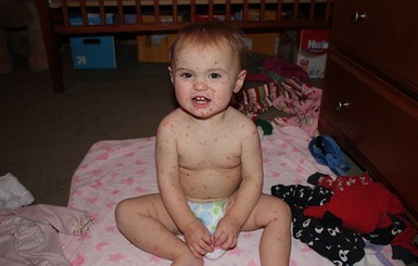 Харьковчане стали в два раза чаще болеть ветрянкой