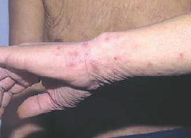 Донбасс атакует чесотка