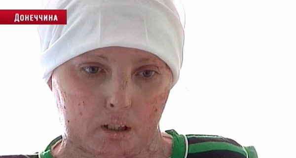 Украинка обожгла 97% кожи из-за короткого замыкания в душевой кабине