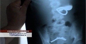 В Севастополе из ребенка достали 30 магнитов