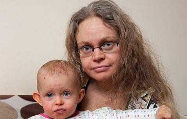 Несчастная женщина, каждый день меняющая кожу, передала болезнь своему малышу 