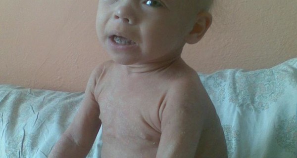 Маленькую одесситку, пережившую клиническую смерть, хотят лечить в Москве