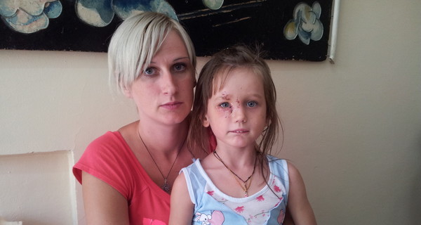 Питбуль вцепился в лицо 5-летней девочки и терзал ее на глазах родителей