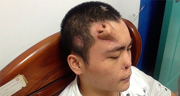 22-летнему китайцу вырастили нос... на лбу