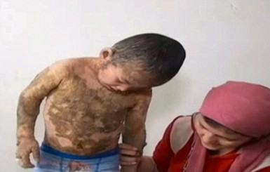 В Казахстане мальчик из-за редкого заболевания стал похож на рептилию