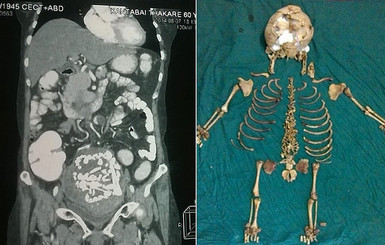 В Индии спустя 36 лет из женщины удалили кости ребенка