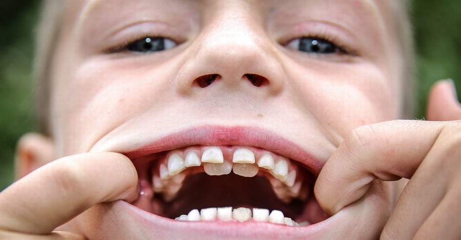 Растут зубы в два ряда у детей: все о второй рядности у ребенка