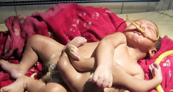 В Индии родился ребенок-божество с четырьмя руками и ногами
