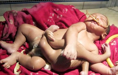 В Индии родился ребенок-божество с четырьмя руками и ногами