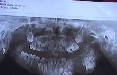 У 7-летнего мальчика удалили 80 зубов