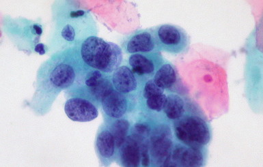 Исследователи случайно перепрограммировали клетки рака