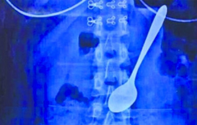 Китайские хирурги обнаружили в желудке девушки металлическую ложку