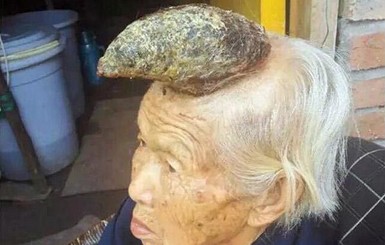 Пожилой китаянке удалили 13-сантиметровый рог