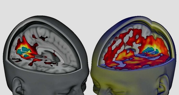 Ученые показали, как выглядит мозг под ЛСД