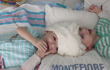 В США 20 часов шла операция по разделению сиамских близнецов, а ее стоимость покрыла страховка