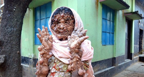 Женщина из Бангладеш с сотнями опухолей мечтает умереть
