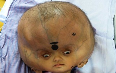 В Индии прооперировали мальчика с самой большой головой