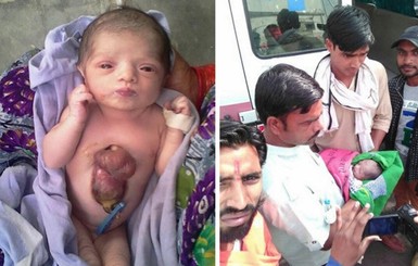 В Индии родилась девочка с сердцем на груди 