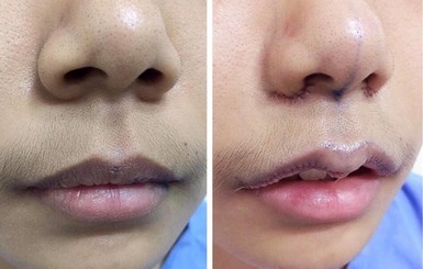 В Азии набирают популярности операции по уменьшению губ