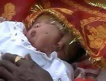 В Индии родилась девочка с двумя лицами на одной голове [ФОТО] 
