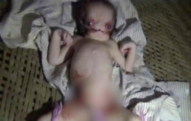 В Индии умер мальчик, который родился без лица